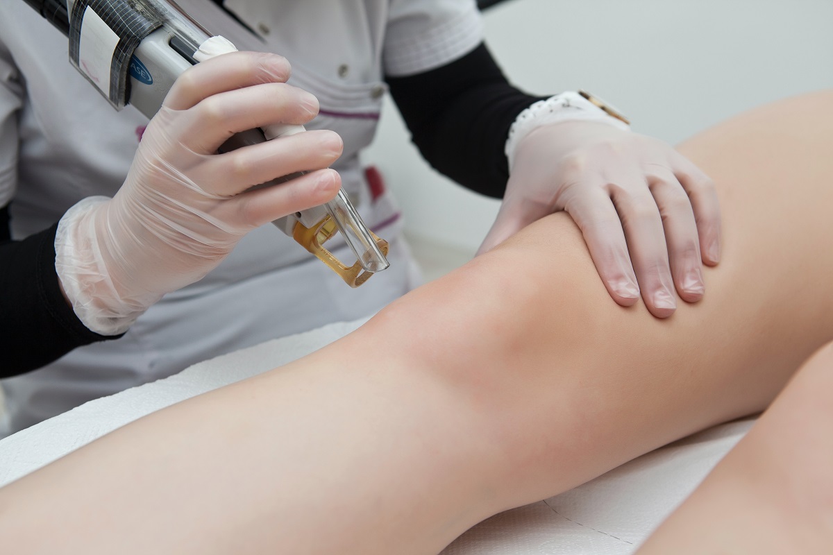 LASER EPILATION